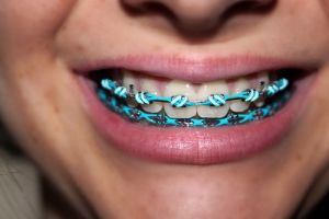 braces