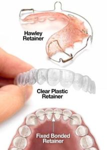 retainers